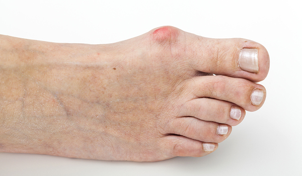 Bunions Diagnosis & Treatment Options in San Mateo