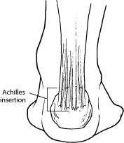 Achilles Tendon Disorders & Diagnosis in San Mateo, CA at Peninsula Foot & Ankle Center