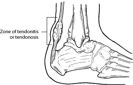 Achilles Tendon Pain and Treatment in San Mateo, CA at Peninsula Foot & Ankle Center
