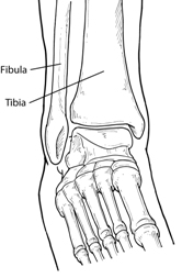 Ankle Fracture Treatment in San Mateo