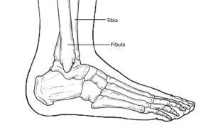 Ankle Fracture Diagnosis in San Mateo, CA