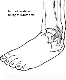 Painful Ankle Diagnosis in San Mateo, CA