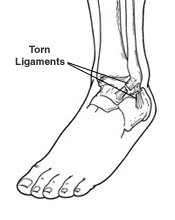 Ankle Sprain Treatment in San Mateo